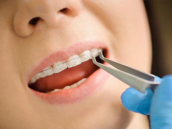 Recetas para comer con ortodoncia ▷ Clínica Dental Suárez Solís